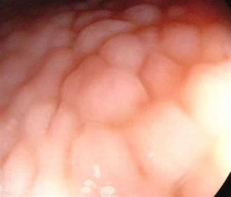 Gastric Nodular Lesions At Upper Endoscopy Figure 2 Diffuse Download Scientific Diagram