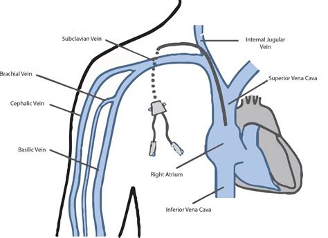 Central Venous Access Dr Ryan Mcconell