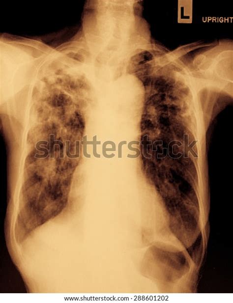 Film Chest Xray Show Alveolar Infiltrate Stock Photo