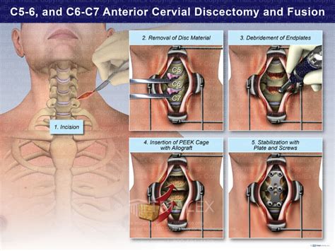 C5 6 And C6 7 Anterior Cervical Discectomy And Fusion Trialques