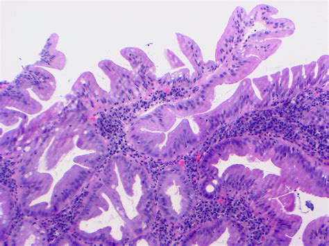 Pathology Outlines Ulcerative Colitis