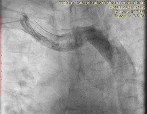 Persistent Left Superior Vena Cava And Absent Right Superior Vena Cava With Left Subclavian Vein