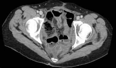 A Pelvic Computer Tomography Scan At The Time Of Recurrence B Pelvic