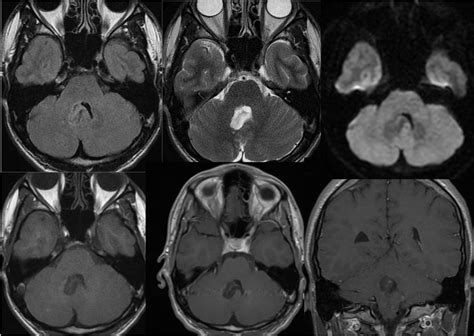 Rosette Forming Glioneuronal Tumor