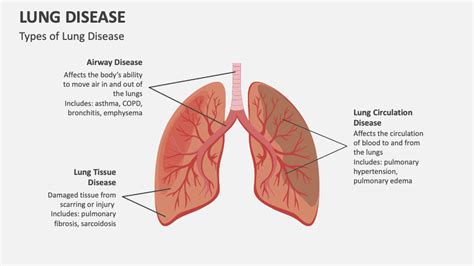 Types Of Bronchiectasis