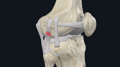 Lateral Collateral Ligament Lcl Injuries Orthopedia