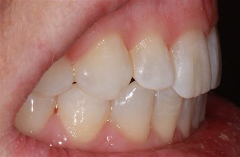 A Simple Minimally Invasive Solution For Crowding And Diastema Closure Smile Oral Health Matters