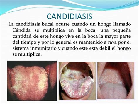 Candidiase Oral O Que Fdplearn