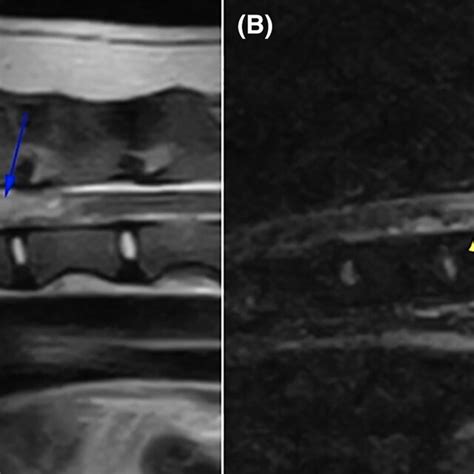 Sagittal T2‐weighted A And Sagittal Short Tau Inversion Recovery