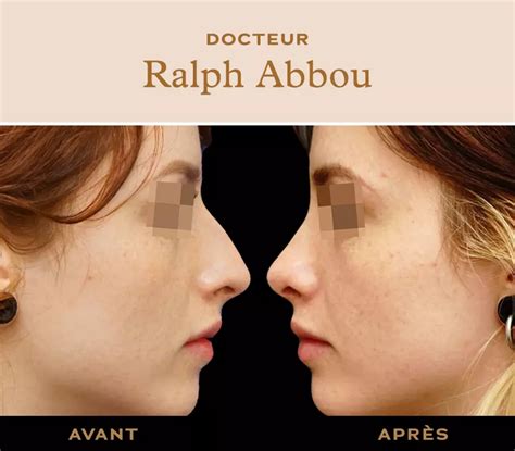 Rhinoplastie à Paris Chirurgie esthétique nez Dr Ralph ABBOU