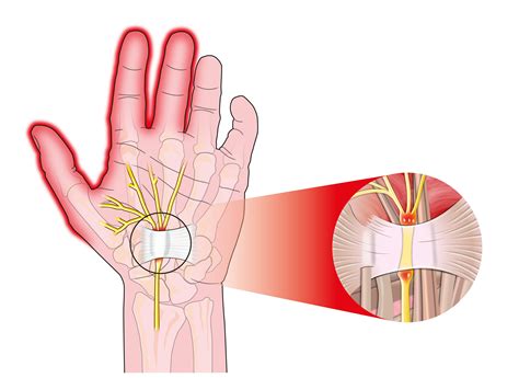 Ulnar Tunnel Syndrome Blog Axis Orthopedic Hospital Blog Axis