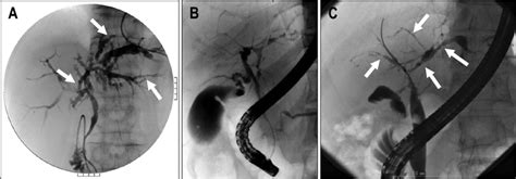 Typical Cholangiographic Features Of Primary Sclerosing Cholangitis Download Scientific