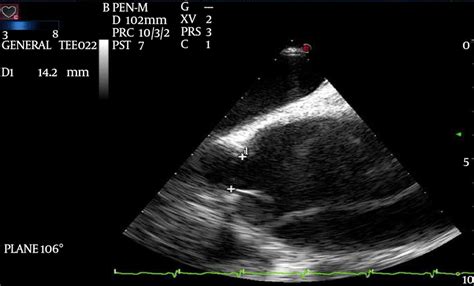 Midesophageal Long Axis LAX View Of The Ascending Aorta With Color