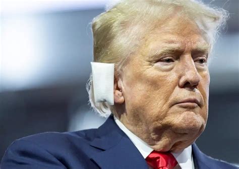 Una Bala Impact En Oreja De Trump No Metralla Asegura Exm Dico Del