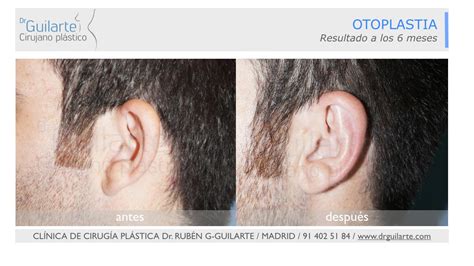 Otoplastia Con Hilos Tensores Qu Es Y En Qu Consiste Dr Guilarte