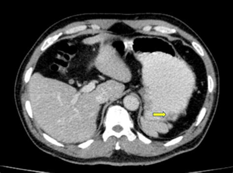 Abdominal Computed Tomography An 18 Mm × 11 Mm Broad Based Nodular