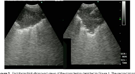 Figure 2 From Endobronchial Ultrasound Guided Transbronchial Needle