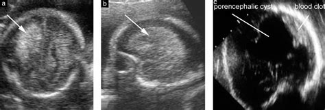 Porencephalic Cyst Ultrasound