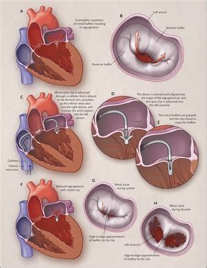 Percutaneous Repair Or Surgery For Mitral Regurgitation NEJM