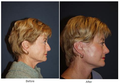 Rhinoplasty Expert In Charlotte Number Of Revisions You Can Get