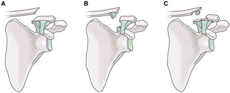 Residual Coracoclavicular Separation After Plate Fixation For Distal Clavicle Fractures