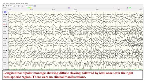 Eeg In Convulsive And Non Convulsive Seizures In The Intensive Care