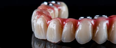 All On 4® Dental Implants Tampa Fl Replacement Teeth Florida