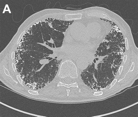 Southwest Journal Of Pulmonary Critical Care And Sleep Imaging Medical Image Of The Week