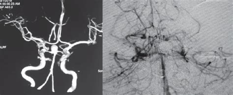 36 years female symptomatic but unruptured left Pcom aneurysm treated ...