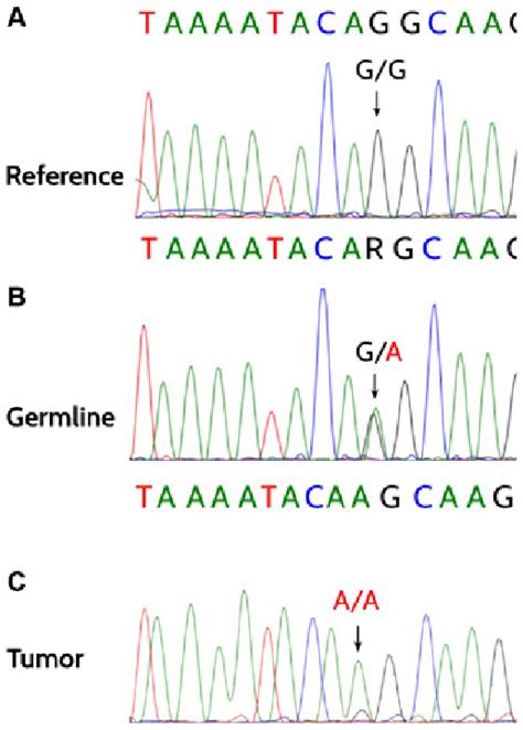 Heterozygous Germline Mutation In BRCA2 Exon 17 C 7976G A