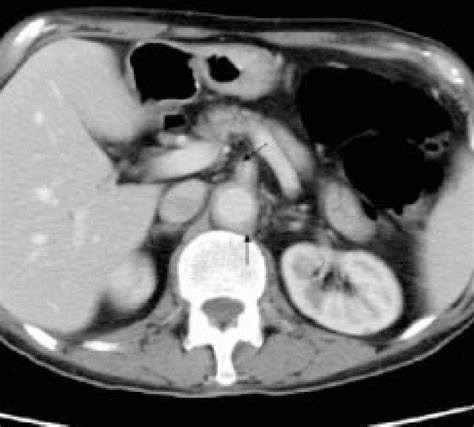 Axial Contrast Enhanced CT Image Through The Upper Abdomen Shows Wall