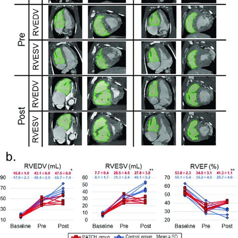 Changes In The Right Ventricular Volume And Right Ventricular Systolic