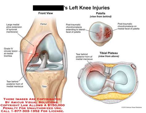 Amicus Illustration Of Amicus Injury Knee Femur Tibia Medial Plica