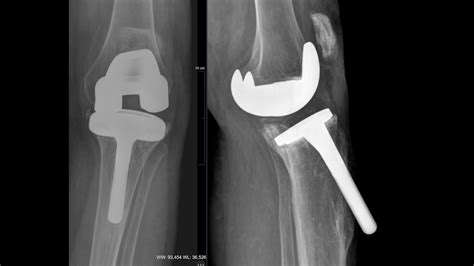 Complex Knee Revision Replacement With Orthopedist Nathan Jove M D