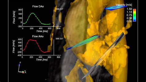 Aortic 4D Flow MRI 3D Blood Flow In A Patient With A Bicuspid Aortic