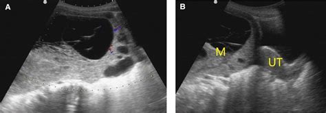 O Rads 4 Pathology Yolk Sac Tumor A Multilocular Cyst Solid