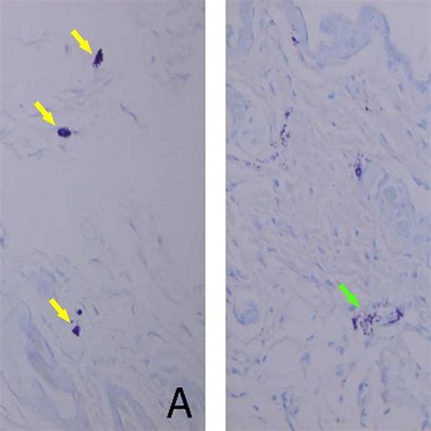 Mast Cell Degranulation Observed In The Ear Skin Of C H Mice By