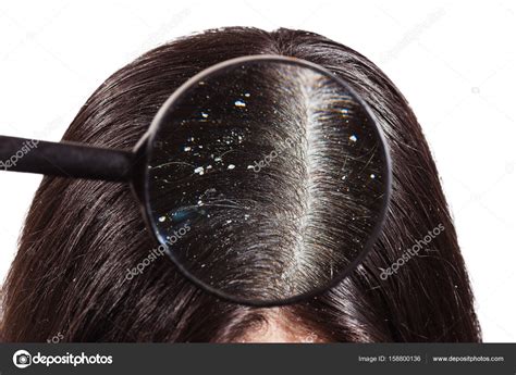 The Doctor Looks Through A Magnifying Glass At The Dandruff On D Stock