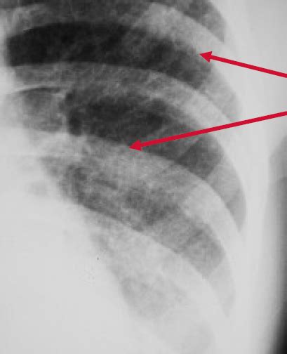 Peribronchial Cuffing Wikidoc