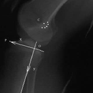 Pdf Fluoroscopic Analysis Of Tibial Translation In Anterior Cruciate