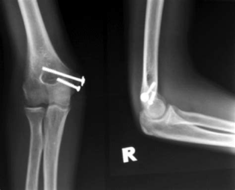 Medial Condyle Humerus Fracture