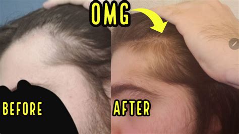 Insane Hair Growth From Oral Minoxidil Incredible Results Hairliciously