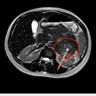 MRI of the abdomen without contrast showing a large heterogeneous mass... | Download Scientific ...