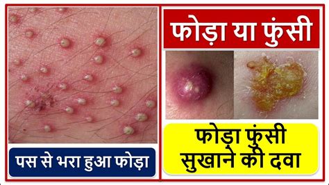 फोड़ा फुंसी सुखाने की दवा पस से भरा हुआ फोड़ा Boils On Skin