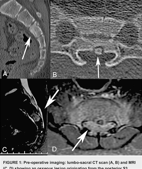 Figure From Minimally Invasive Resection Of An S Osteoid Osteoma