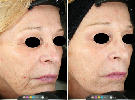 Before And After Vivace Rf Microneedling Aivi Aesthetics Skin Health