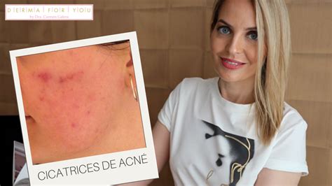 Diferentes tratamientos para eliminar cicatrices de acné Dermaforyou