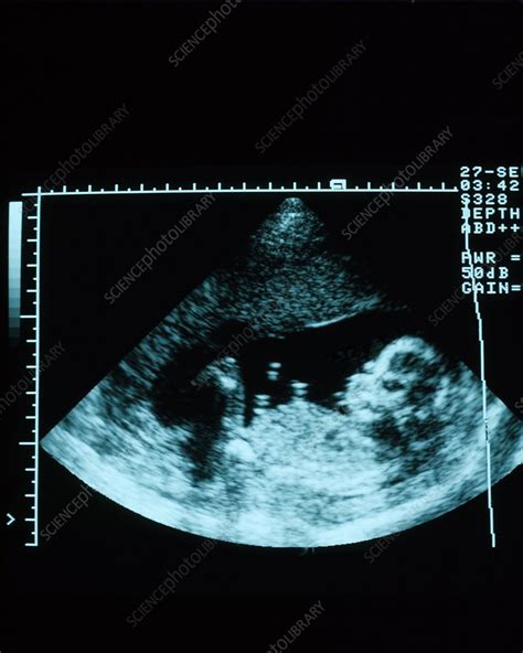 Foetus At 16 Weeks Ultrasound Stock Image C0489174 Science