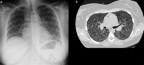 Chest X Ray Miliary Tb