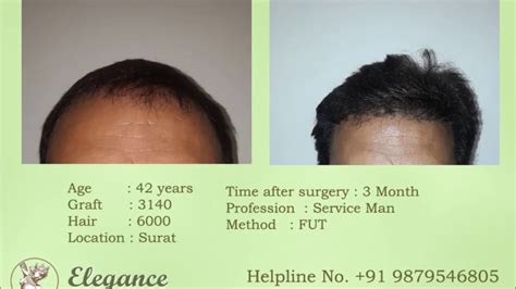 Effect Of Workout After Hair Transplant By Dr Ashutosh Shah Sruat